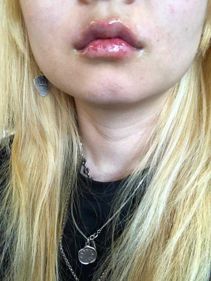 필러 맞은 당일