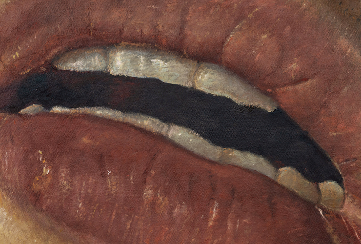 ‘Angular Cheilitis’(2022)